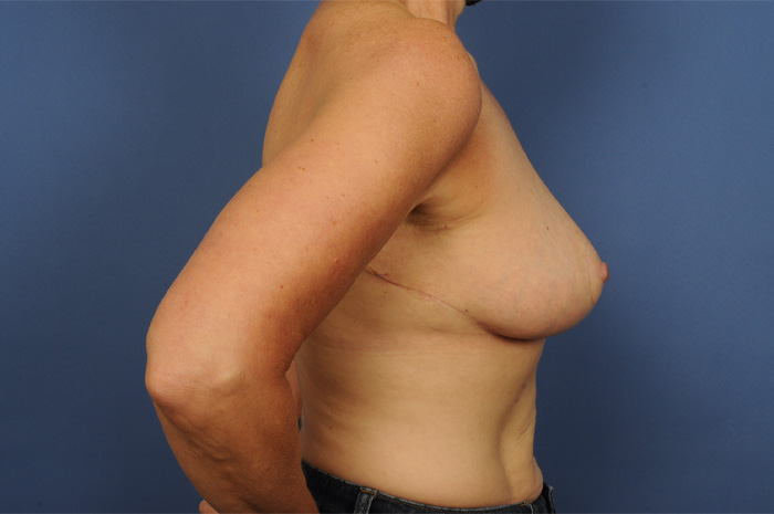 Lumpectomy Before & After Image