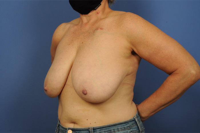 Lumpectomy Before & After Image