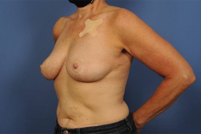 Lumpectomy Before & After Image