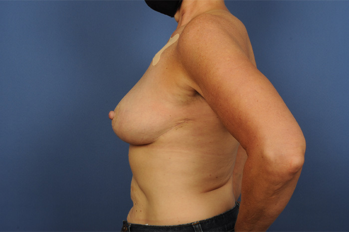 Lumpectomy Before & After Image