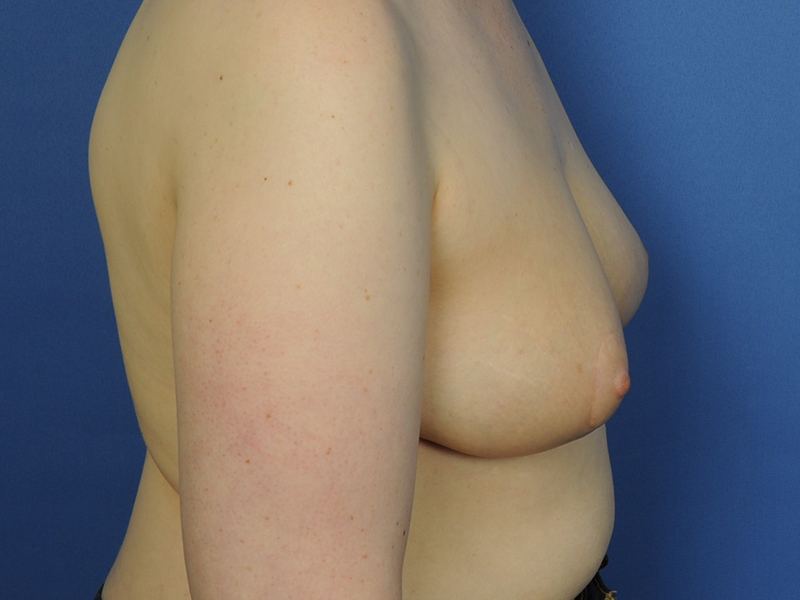 Lumpectomy Before & After Image