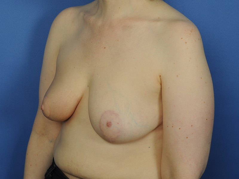 Lumpectomy Before & After Image