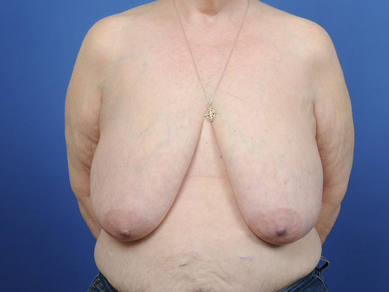 Lumpectomy Before & After Image