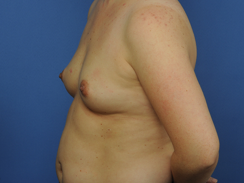 Lumpectomy Before & After Image