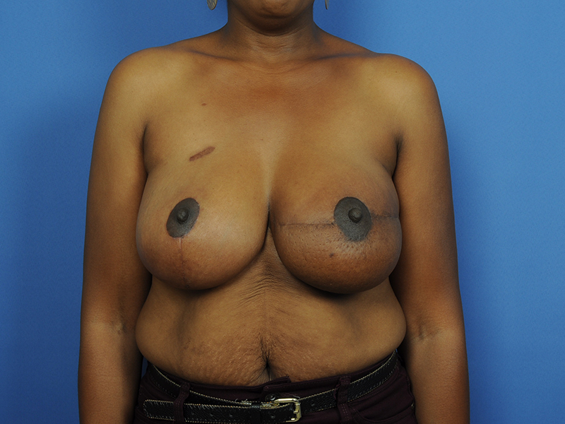 Lumpectomy Before & After Image