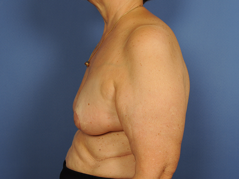 Lumpectomy Before & After Image