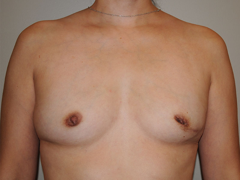 Lumpectomy Before & After Image