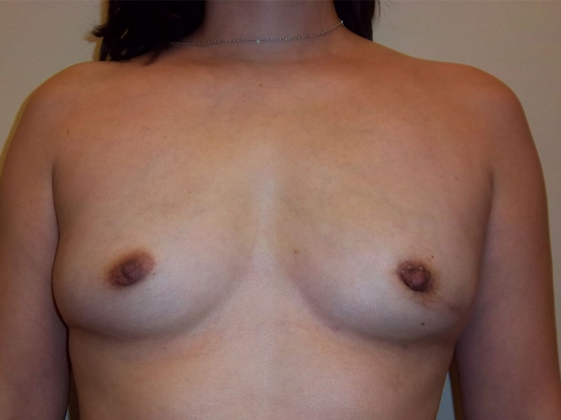 Lumpectomy Before & After Image