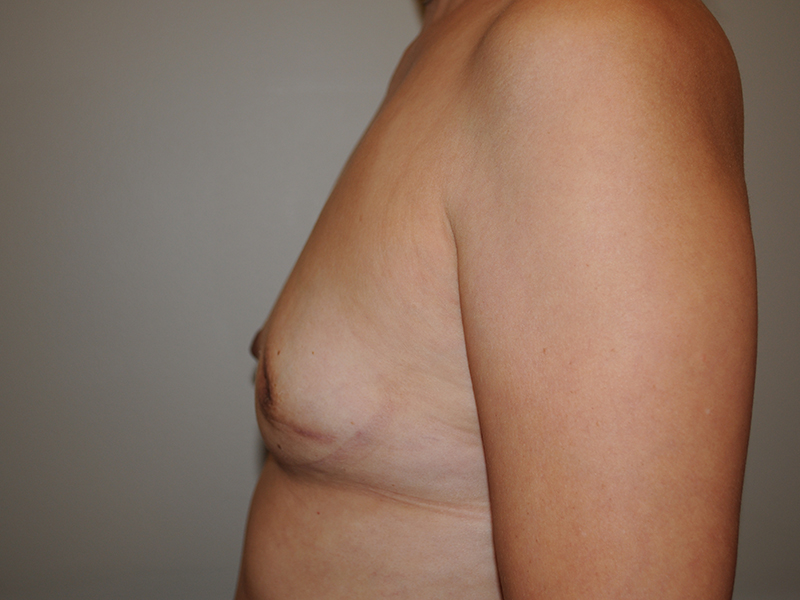 Lumpectomy Before & After Image