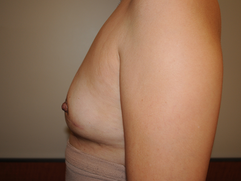 Lumpectomy Before & After Image