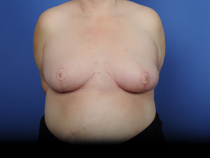 Lumpectomy Before & After Image