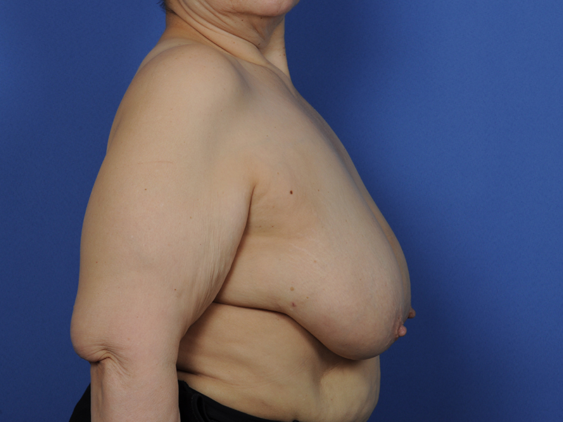 Lumpectomy Before & After Image