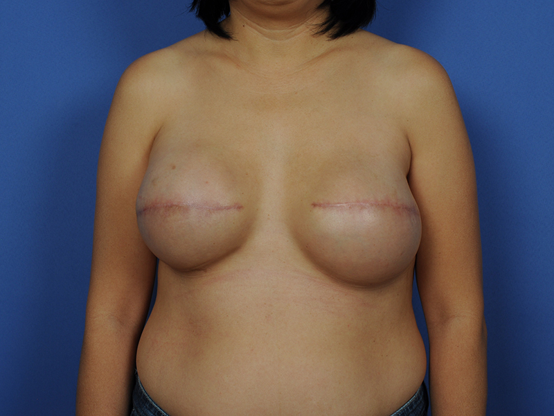 Nipple Reconstruction Before & After Image