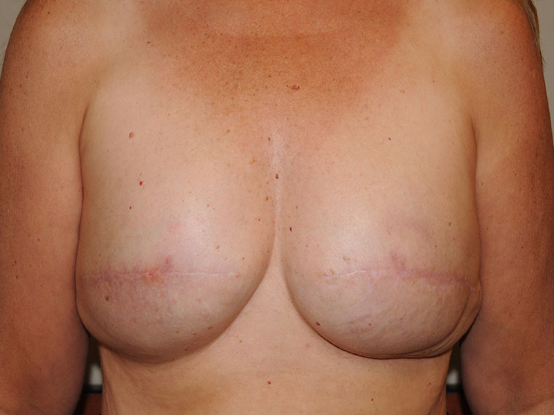 Nipple Reconstruction Before & After Image