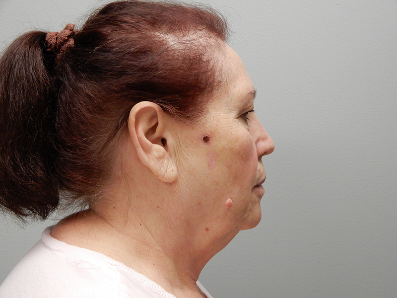 Cheek Reconstruction Before & After Image