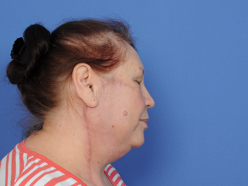 Cheek Reconstruction Before & After Image