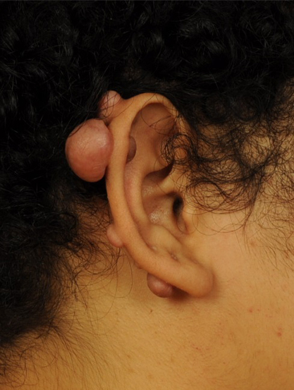 Ear Reconstruction Before & After Image