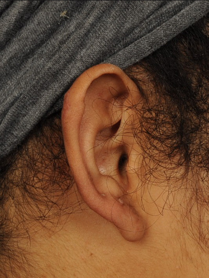 Ear Reconstruction Before & After Image