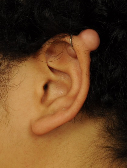 Ear Reconstruction Before & After Image