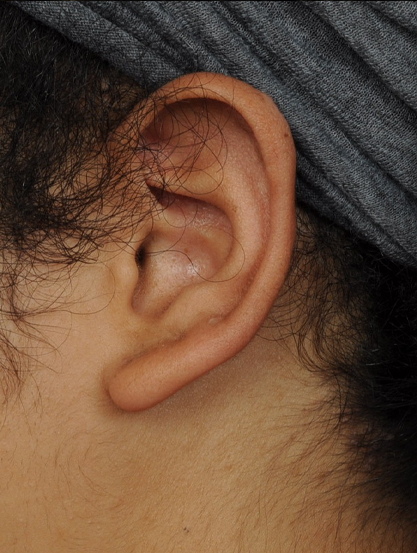 Ear Reconstruction Before & After Image