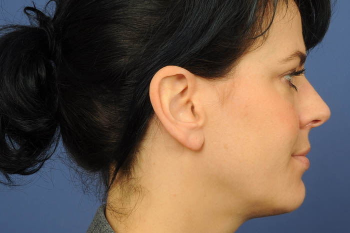 Ear Reconstruction Before & After Image