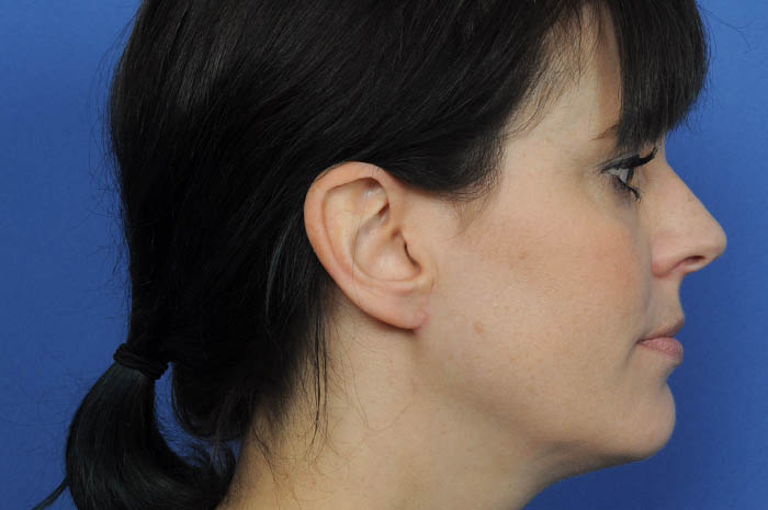 Ear Reconstruction Before & After Image