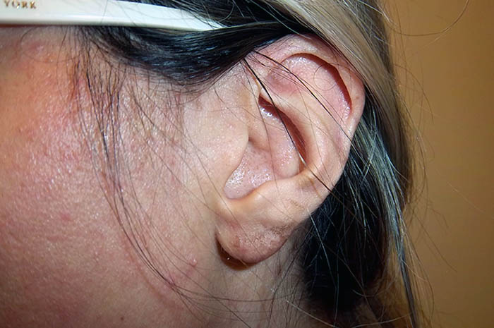 Ear Reconstruction Before & After Image