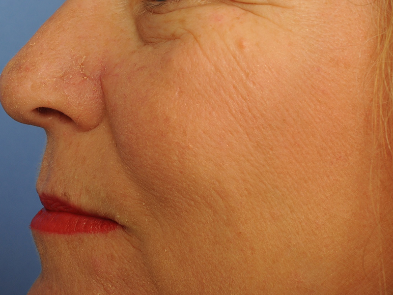 Nasal Reconstruction Before & After Image