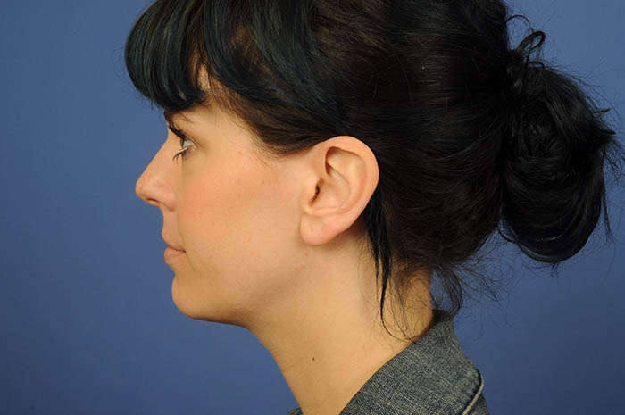 Ear Lobe Repair Before & After Image