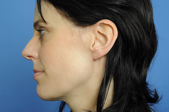 Ear Lobe Repair Before & After Image