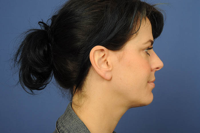 Ear Lobe Repair Before & After Image