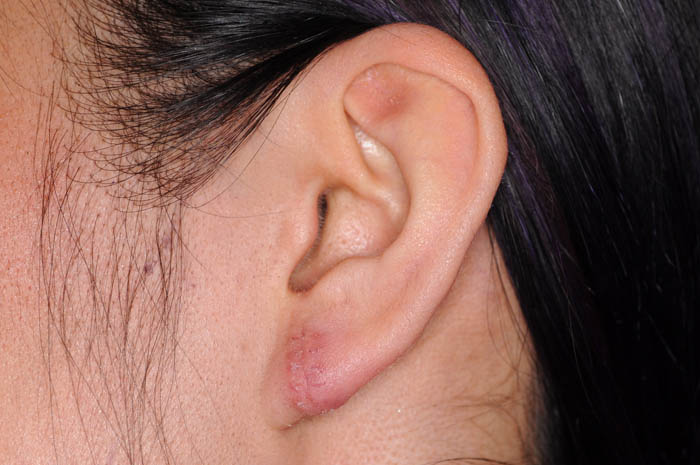 Ear Lobe Repair Before & After Image