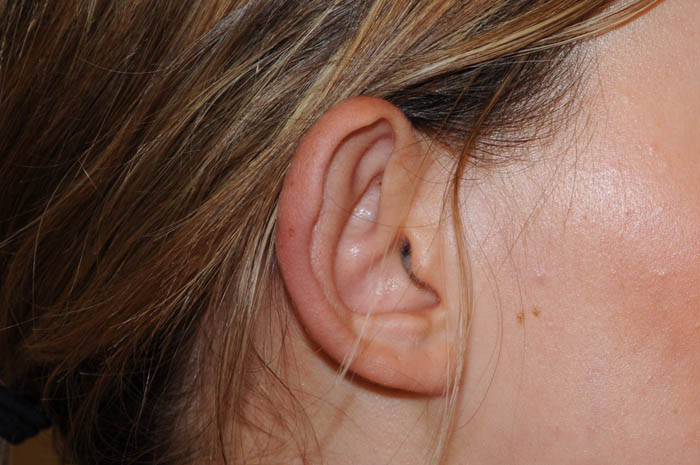 Ear Surgery Before & After Image