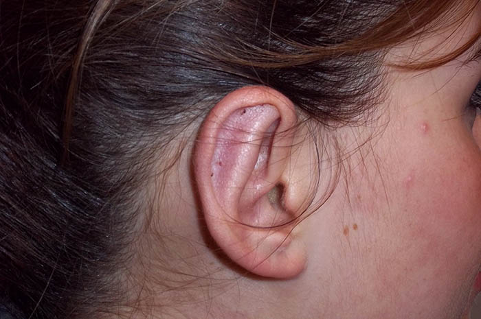 Ear Surgery Before & After Image