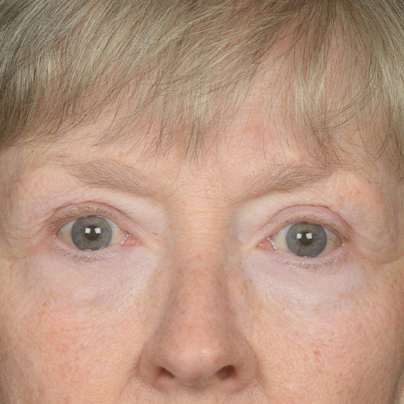 Eyelid Surgery Before & After Image