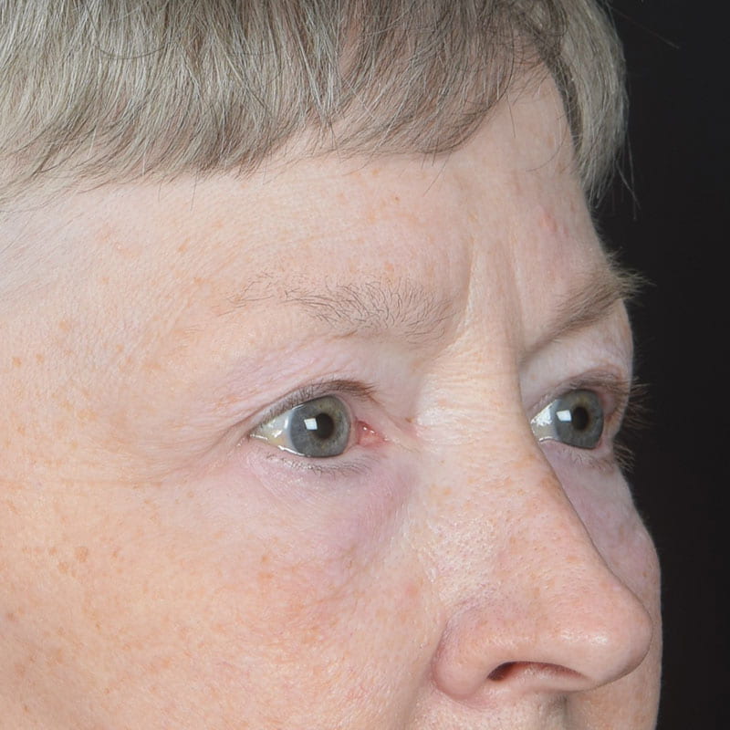 Eyelid Surgery Before & After Image