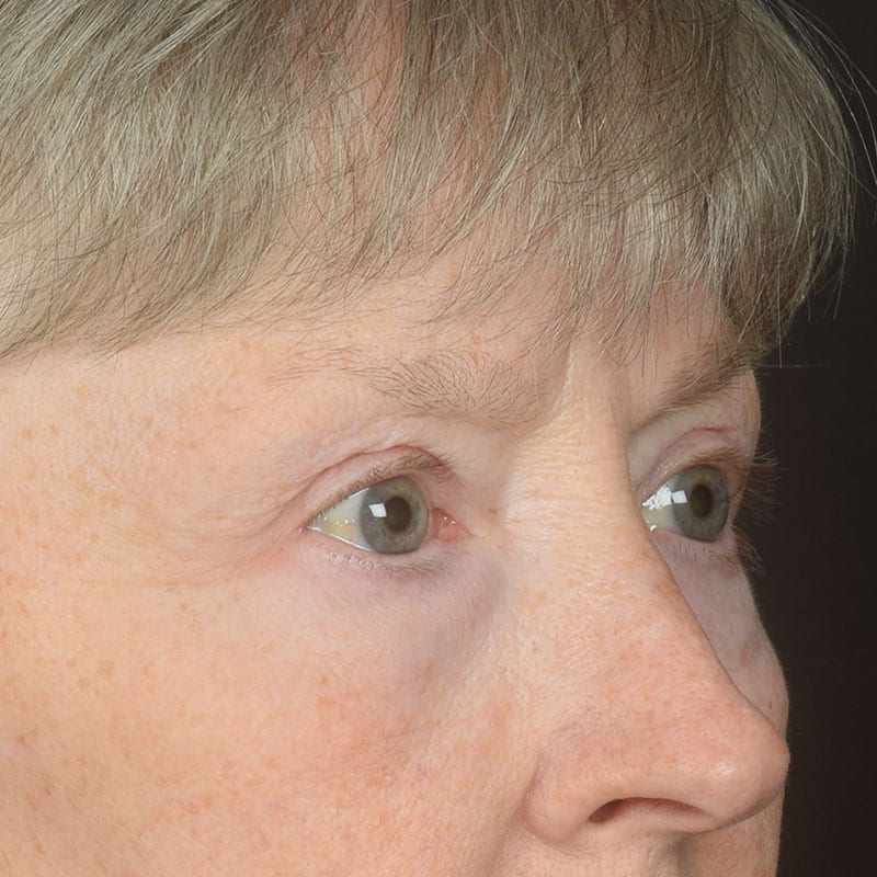 Eyelid Surgery Before & After Image