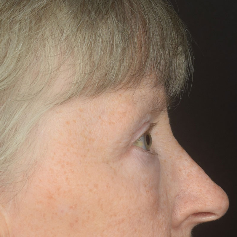 Eyelid Surgery Before & After Image