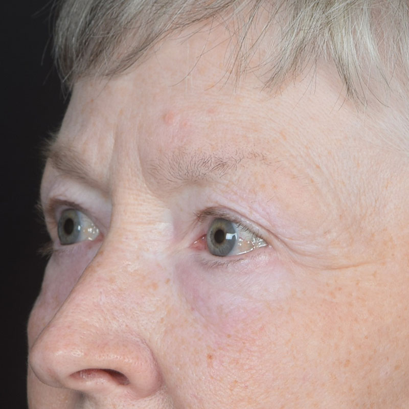 Eyelid Surgery Before & After Image