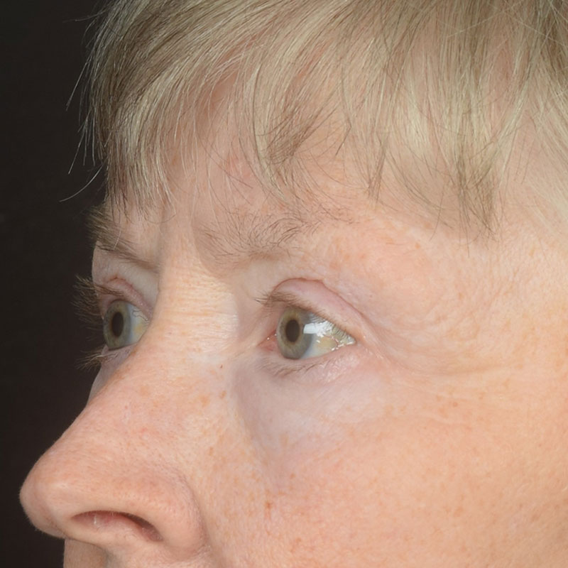 Eyelid Surgery Before & After Image