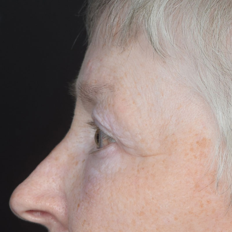 Eyelid Surgery Before & After Image