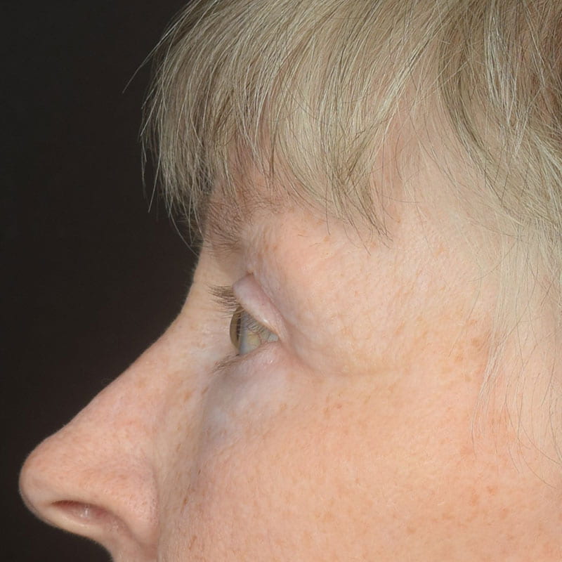 Eyelid Surgery Before & After Image