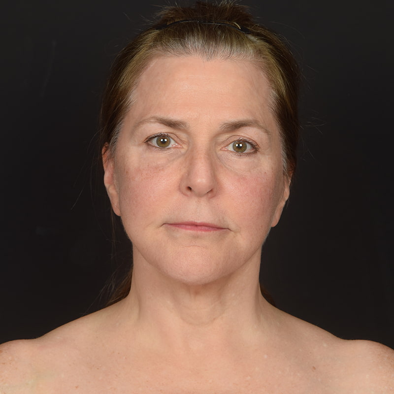 Eyelid Surgery Before & After Image