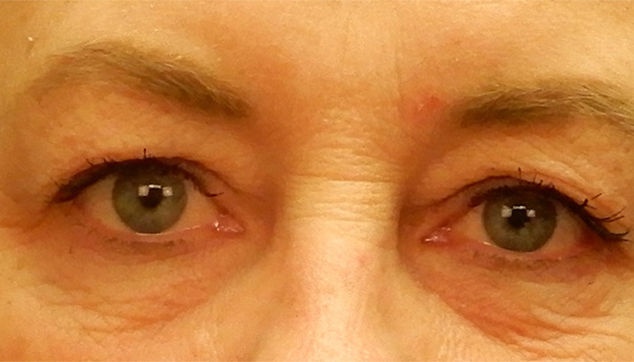 Eyelid Surgery Before & After Image