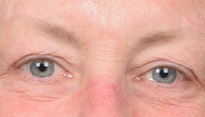 Eyelid Surgery Before & After Image