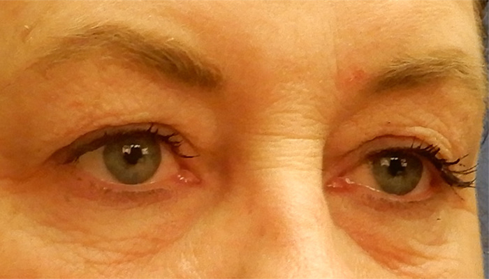 Eyelid Surgery Before & After Image