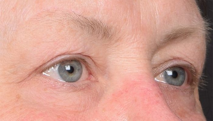 Eyelid Surgery Before & After Image