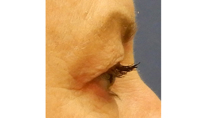 Eyelid Surgery Before & After Image