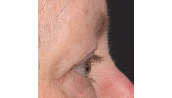 Eyelid Surgery Before & After Image