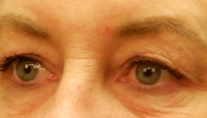 Eyelid Surgery Before & After Image